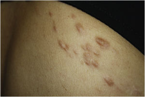 Small and elastic nodules/papules with poorly defined borders, covered by normal skin located on the shoulder