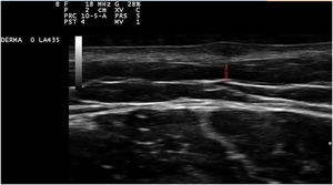 Ultrasonography shows a hypoechoic lesion located in deep dermis (arrow)