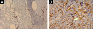 (A) Immunohistochemical analysis showing immunoexpression of CD138 in the cytoplasmic membrane of interstitial plasma cells that permeate the lymphoid aggregates (×100). (B) Cytoplasmic immunoexpression of factor XIIIa in spiky multinucleate cells (arrow; ×400)