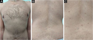 Decrease in the number, pigmentation and size of the lesions after one year in the anterior thoracic region (A) and back region (B and C).