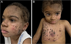 Erythematous scaling plaques with well-defined edges and thick adhered crusts on the face (A) and trunk (B)