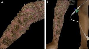 Thick vegetative crusts on erythematous plaques affecting the entire right lower limb (A‒B)