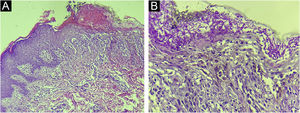 (A) Irregular acanthosis, spongiosis and keratotic crust are observed, in addition to dermal edema with areas of blurring of the dermal-epidermal junction (Hematoxylin & eosin, ×100). (B) Presence of numerous hyphae and spores in the stratum corneum (Periodic Acid-Schiff, ×400)