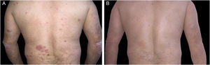 (A) Scaling erythematous plaques on the back and elbows. (B) Complete resolution after treatment with etanercept