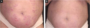 (A) Erythematous plaques on the abdomen. (B) Complete resolution after treatment with risankizumab