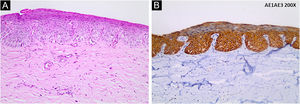 Histopathology and immunohistochemistry findings: (A) Intraepidermal lesion with proliferation of atypical keratinocytes with loss of polarity (Hematoxylin & eosin, ×200). (B) Positive immunohistochemistry for AE1/AE3 (Pan-cytokeratin, ×200)