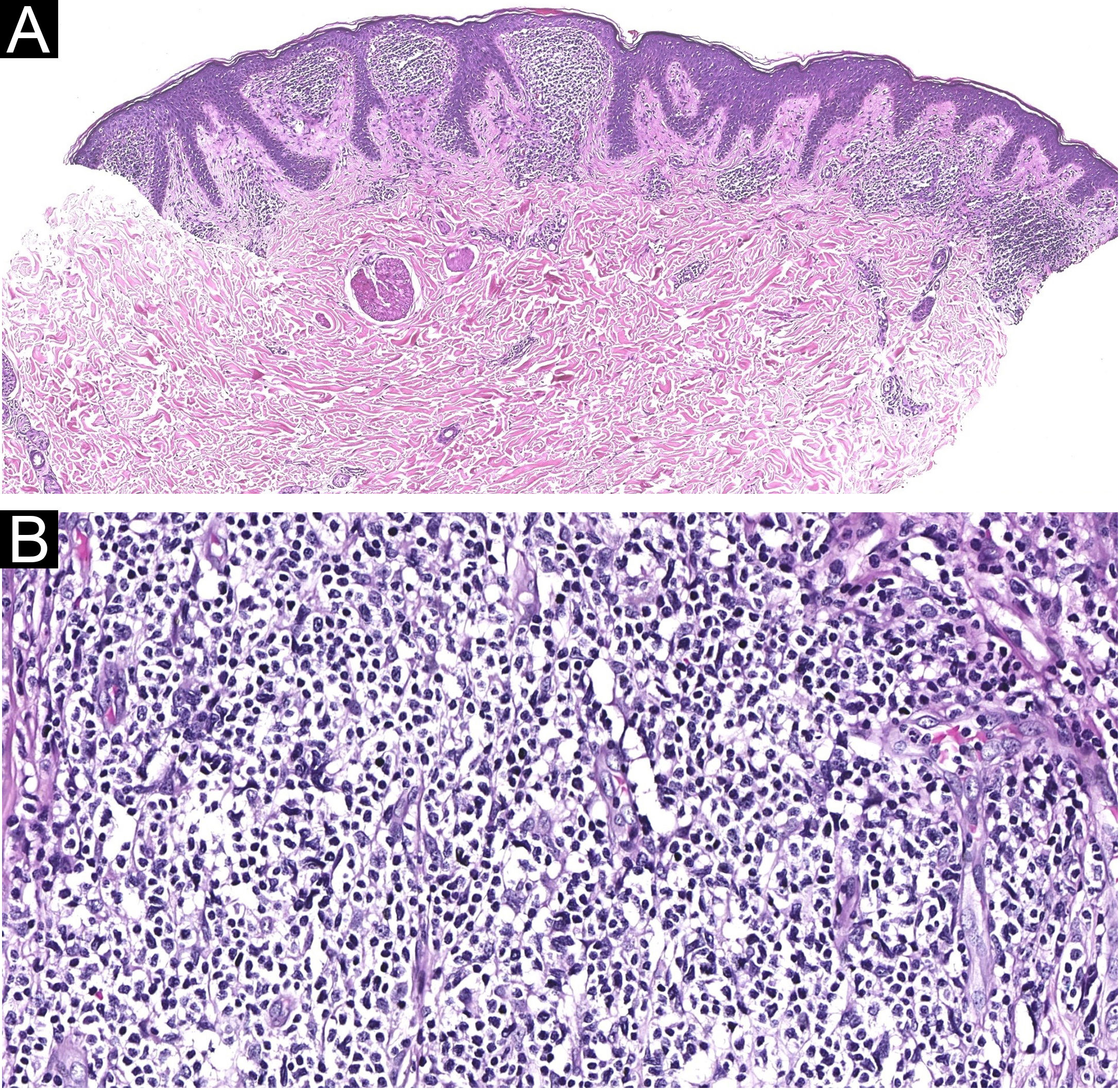 Dense Vs Diffuse Rash Primary cutaneous CD4+ small/medium T-cell lymphoproliferative disorder ...
