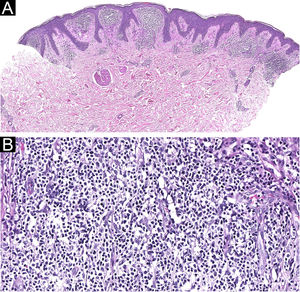 (A) Diffuse, dense infiltrate filling the papillary dermis, without prominent epidermotropism (Hematoxylin & eosin, ×20). (B) Small to medium-sized lymphoid cells, with mild pleomorphism (Hematoxylin & eosin, ×200)
