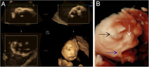 (A) 3-D ultrasound: the image of the face of the fetus. (B) 3-D ultrasound: eyelid edema and ectropion (black arrow); Hypoplastic nose (white arrow); Eclabium and anterior tongue protraction (blue arrow)