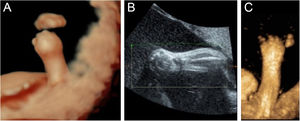 (A) 3-D ultrasound: clenched hands and skin oedema. (B) 2-D ultrasound: a shortening of phalanges and metacarpals. (C) 3-D ultrasound: the image of the upper limb of the fetus