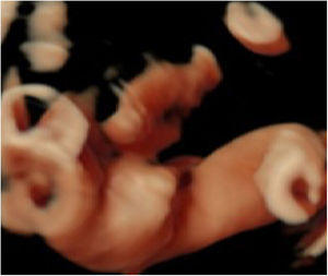 3-D ultrasound: no testicles seen in scrotum