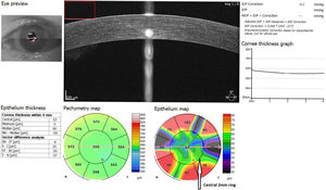 Mean corneal epithelial thickness maping with SD-OCT. Central 2-mm zone ring indicated by the white arrow. Mean corneal epithelial thickness in central 2-mm zone used in the analysis of measurements. Unit: μm