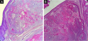 (A and B) Proliferation of lobular squamous tumor islands in the dermis, without connection with the epidermis. There is trichilemmal-type keratinization, consisting of compact and eosinophilic keratin in the center, in two distinct areas (Hematoxylin & eosin, ×40)
