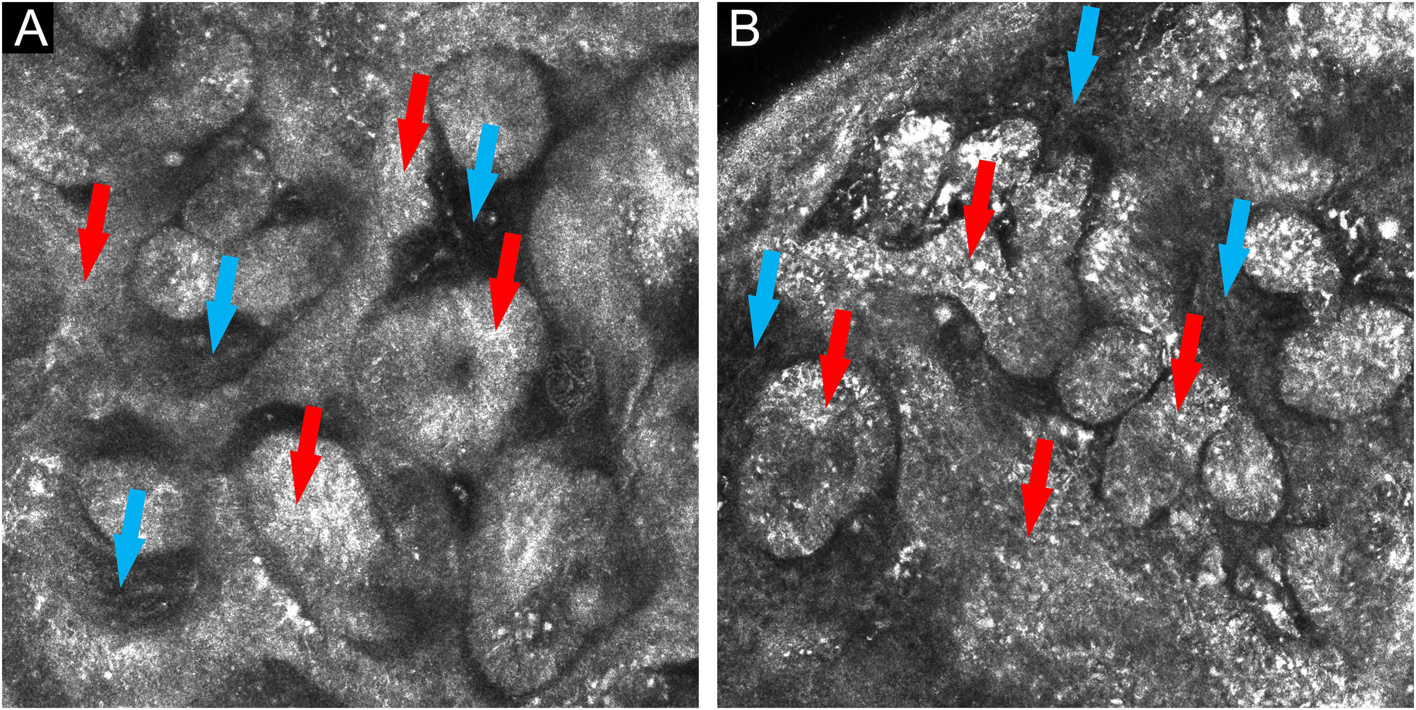 Fep Derm Fibroepithelioma of Pinkus – confocal microscopy as a diagnostic tool ...