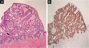 (A) Histopathology of the lesion showing cords of tumor cells with a palisaded periphery (Hematoxylin & eosin, ×40). (B) Immunohistochemistry demonstrating the expression of BER-EP4 in the cords of tumor cells (×40)
