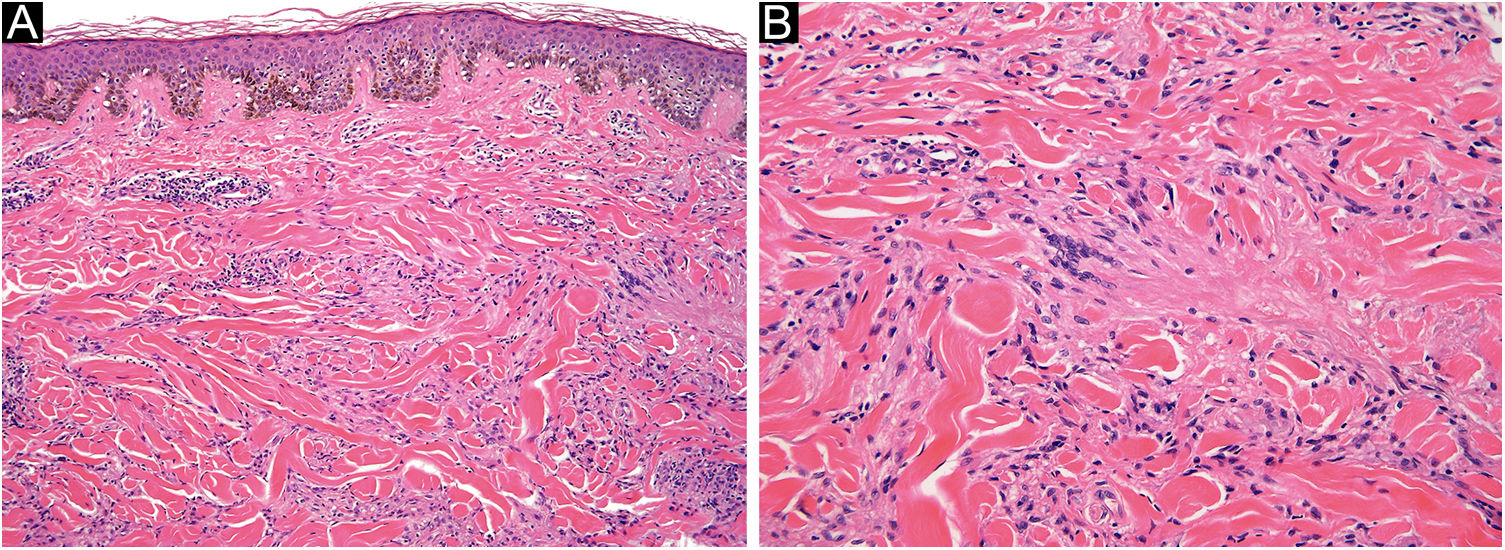 Annular Elastolytic Giant Cell Granuloma An Unusual Presentation In 