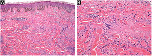 (A) Hematoxylin & eosin, 100×; perivascular and interstitial infiltrate with lymphocytes and numerous histiocytes. Collagen degeneration areas surrounded by multiple histiocytes and multinucleated giant cells. (B) Hematoxylin & eosin, 200×; collagen degeneration on the dermis