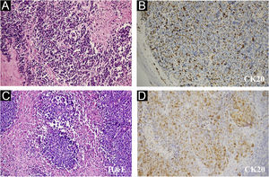 Pathological features of the finger neoplasm (A‒B) and left axilla lymph nodes (C‒D). (CK20, Cytokeratin 20, 200×)