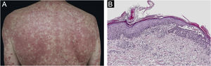 Clinical and histopathological images of the patient. (A) Salmon coloured plaques with superficial desquamation and islands of sparing. (B) Follicular plugging with parakeratosis at the edges of follicular orifice and marked acantholysis at multiples areas (Hematoxylin & eosin, ×10)