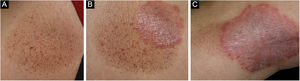 (A) A number of small brownish lentiginous patches appeared after improvement of psoriasis. (B) Psoriatic plaques were observed within part of the pigmentary macule. (C) Psoriasis occurred within the pigmentary macule and spread beyond the pigmentary macule