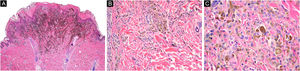Case 2. (A) Wedge-shaped melanocytic proliferation at the dermal-epidermal junction and superficial dermis, intensely pigmented (Hematoxylin & eosin, ×2). (B) Epithelioid and dendritic melanocytic cells arranged in nests, some pigmented, with signs of maturation towards depth (Hematoxylin & eosin, ×10). (C) Neoplastic cells with wide cytoplasm, abundant granular brown melanin pigment, and slightly hyperchromatic and pleomorphic nuclei, with prominent nucleoli (Hematoxylin & eosin, ×40)