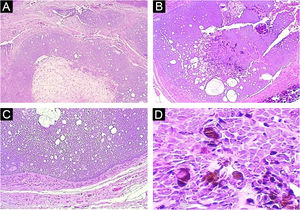 (A) Panoramic view: note the lack of connection with the epidermis and the solid-cystic component of the neoplasm (Hematoxylin & eosin, ×40). (B) Panoramic view of the deep part of the tumor, highlighting the biphasic aspect of the neoplasm and the pigmentation focus (Hematoxylin & eosin, ×40). (C) Note the peripheral palisade and cleft artifact between the neoplasm stroma and adjacent dermis (Hematoxylin & eosin, ×100). (D) Detail of basaloid epithelial cells with intense cytoplasmic melanic pigmentation (Hematoxylin & eosin, ×400)