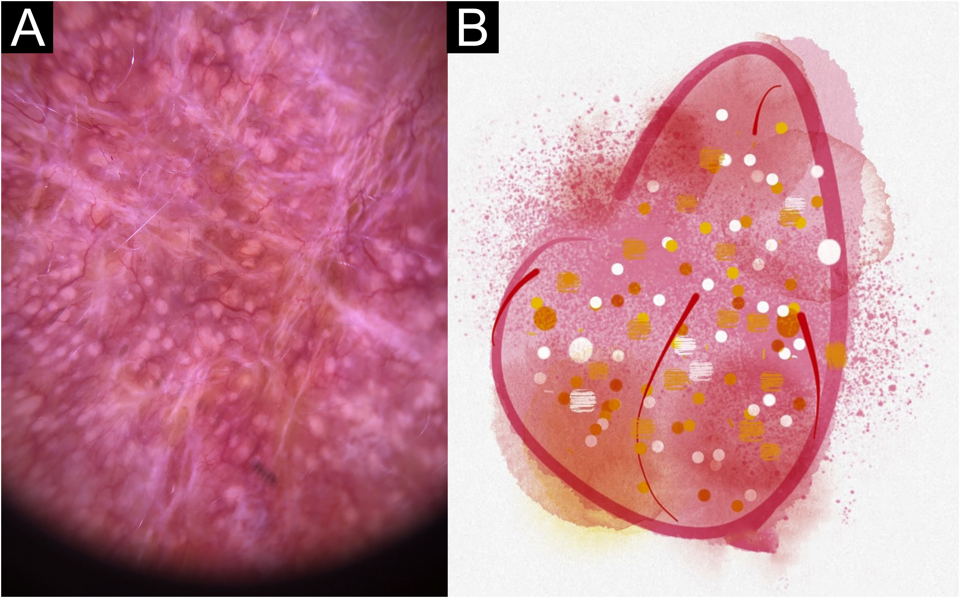 Description Of The Dermatoscopic Features Observed In Sporotrichosis description-of-the-dermatoscopic-features-observed-in-sporotrichosis