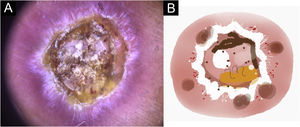 Cutaneous leishmaniasis ulcer crustose lesion of patient (n = 29) on the arm, at the initial medical appointment. (A) Dermoscopy. (B) Illustration of the dermoscopic pattern: “central yellow scales with white perilesional circle”. The “central yellow scales with white perilesional circle pattern” is composed of general erythema, central ulcer with hyperkeratosis, microulcerations, focal structureless white areas, white lines, white dots, polymorphic vessels (mostly glomerular vessels, dotted vessels), surrounding by white perilesional circle