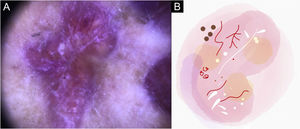 Sporotrichosis lesion of patient (n = 69) on the arm, thirty days after the beginning of the treatment. (A) Dermoscopy. (B) Illustration of the dermoscopic pattern “Focal structureless white areas with erythema pattern. The “Focal structureless white areas with erythema pattern” is composed of general erythema, focal structureless white areas, white lines, white dots, focal structureless yellow areas, polymorphic vessels (mostly glomerular vessels and doted vessels)