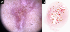 Sporotrichosis hypertrophic cicatricial lesion with central linear disposition of patient (n = 69) on the arm, at cure. (A) Dermoscopy. (B) Illustration of the dermoscopic pattern “white linear”. The “white linear pattern” is composed of general erythema, white lines, focal structureless white areas, white dots, black/brown dots, black lines, comedones and polymorphic vessels (mostly irregular linear vessels)