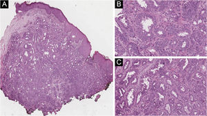 (A) Histology showing a well-circumscribed, non-encapsulated dermal glandular proliferation (Hematoxylin & eosin, ×100). (B‒C) Ductal structures lined with cuboidal epithelial cells, which present apocrine secretory projections on its luminal border (Hematoxylin & eosin, ×400)