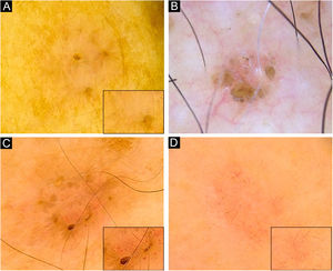 Dermoscopy of superficial very small BCCs. (A) 3mm BCC located on the upper limb, displaying blue-gray dots, polymorphous vessels (magnified on square) with hairpin, comma, glomerular and linear irregular vessels, and SWS blotches. (B) 3mm BCC located on the chest, displaying leaf-like structures, ovoid nests, micro-erosions and white scales. (C) 3mm BCC located on the upper limb, showing blue-gray dots and globules, leaf-like structures, polymorphous vessels (magnified on square) with SFT, hairpin and comma vessels, and SWS blotches. (D) 3mm BCC located on the upper limb, presenting blue-gray dots, polymorphous vessels (magnified on square) with SFT and hairpin vessels, and SWS blotches