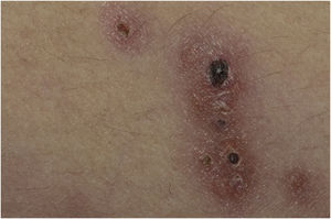 Detail of the erythematous-violaceous ulcerated nodules, with hematic necrotic crusts
