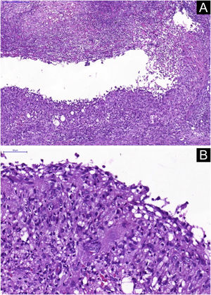 Histopathological analysis. (A) Neutrophilic granulomatous inflammatory process, with superficial and deep involvement of the dermis (Hematoxylin & eosin, ×200). (B) Epithelioid granulomatous inflammatory process surrounding a cystic necrotic cavity containing neutrophils and cell debris (Hematoxylin & eosin, ×400)