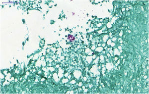 Histopathological analysis: detail showing the presence of acid-fast bacilli (AFB) forming extracellular aggregates (Ziehl Neelsen, ×400)