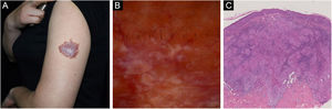 Cutaneous sarcoidosis on the left upper arm. (A) Clinical presentation. (B) Dermoscopic examination reveals diffuse orangish color as well as well-focused linear-irregular vessels; scar-like whitish areas are also visible. (C) Typical histopathological features of sarcoidosis