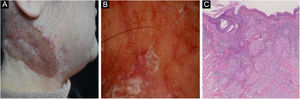 Cutaneous sarcoidosis on the neck. (A) Clinical presentation. (B) Dermoscopic assessment shows focal orangish areas and several well-focused linear/linear-irregular vessels; follicular whitish keratotic plugs and scar-like whitish areas are also present. (C) Typical histopathological features of sarcoidosis