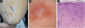 Cutaneous sarcoidosis on the elbow. (A) Clinical presentation. (B) Dermoscopic assessment shows focal orangish, well-focused linear/linear-irregular vessels, whitish linear areas and scar-like whitish areas. (C) Typical histopathological features of sarcoidosis