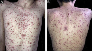 (A) Varicella in renal transplant patient: isolated and confluent lesions, disseminated over the trunk. (B) Progression to a necrohemorrhagic pattern