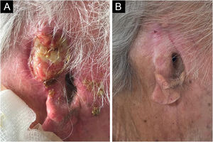 (A) Extensive tumor affecting the auricular pinna and adjacent structures. (B) Cicatricial lesion on the pinna after four months using cemiplimab.