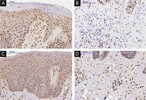 IL-31 immunohistochemistry in lesional skin of an Atopic Dermatitis (AD) subject, epidermis (A) and superficial dermis (B), (A and B) Pre-Methotrexate (MTX) treatment; lesional skin of an AD subject, epidermis (C) and superficial dermis (D), (C and D) Post-MTX treatment (200× magnification)