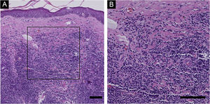 Histological Findings of PC-SMTLD. No obvious abnormalities were observed in the epidermis and diffuse lymphoid cell infiltration was observed in the entire dermis. At high magnification, a large number of small to medium sized lymphocytes were seen in the dermis, with mast cells, plasma cells, and eosinophils scattered in the background. (Hematoxylin & eosin, scale bar = 100 μm).