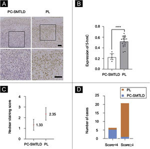 Expression of 5-hmC. primary cutaneous CD4+ small/medium sized pleomorphic T-cell lymphoproliferative disorder (PC-SMTLD) and Pseudolymphoma(PL): significant decrease of 5-hmC expression was observed in PC-SMTLD when compared with PL in dermis (Fig. 3A). (****p < 0.0001). (Fig. 3B). The difference in nuclear staining score for 5-hmC was statistically significant with higher scores in the PL group (mean = 2.35, Standard Deviation [SD = 0.50]) when compared to PC-SMTLD (mean = 1.33, SD = 0.47, p = 0.0014) (Fig. 3C). The majority of PL 95% (19/20) cases were in the high expression group (Fig. 3D).