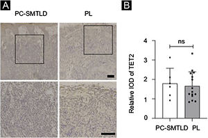 Expression of TET2: No significant difference in TET2 expression were observed in two groups.