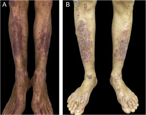 (A) Patient showing improvement of psoriasis lesions after withdrawal of atezolizumab and bevacizumab infusion; (B) Patient showed recurrence of psoriatic lesions after a new infusion, as erythematous-desquamative plaques with pustules.