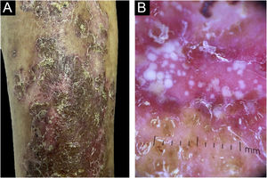 (A) Detail of the clinical lesions on the legs, showing erythematous-desquamative plaques with pustules; (B) Dermoscopy showing the pustules.