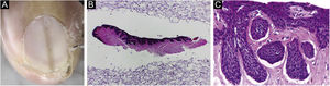 (A) Melanonychia – contact dermoscopy. (B‒C) Pigmented onychomatricoma: The specimen adequately embedded in longitudinal section. Hematoxylin & eosin, original magnification ×40, ×200.
