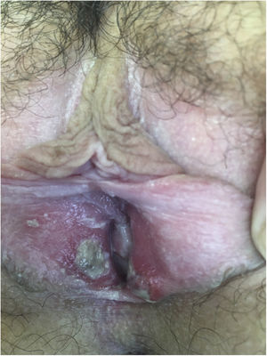 Fibrinous kissing ulcers on the vulva.