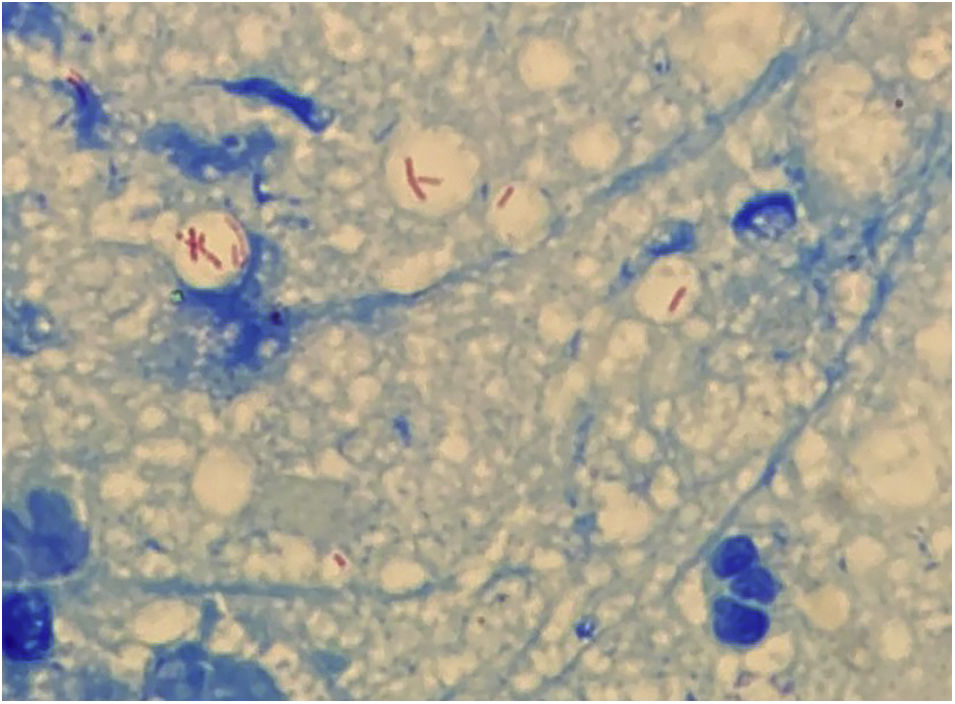 Abscessis Mycobacterium abscessus sporotrichoid infection after a dog bite ...
