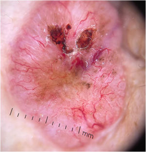 A BCC approximately 20 mm in diameter, characterized by prominent arborizing telangiectasia, ulceration, and brown structures